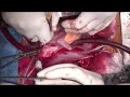 Transcaval Repair of High Sinus Venosus ASD-Can We Avoid a Warden Procedure?