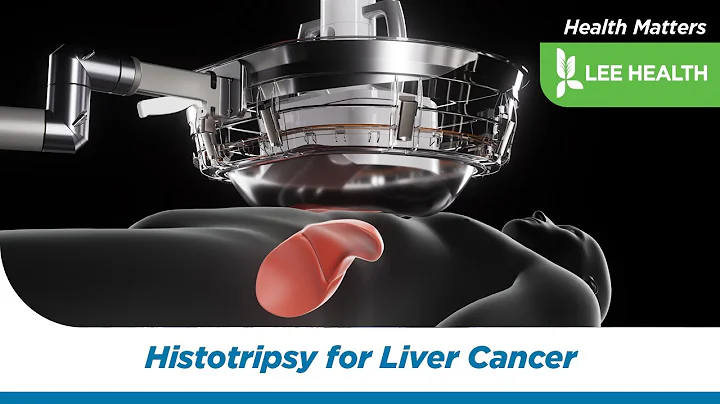 Histotripsy for Liver Cancer
