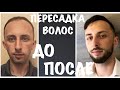 ПОЛНЫЙ РЕЗУЛЬТАТ ПЕРЕСАДКИ ВОЛОС В ТУРЦИИ / ДО И ПОСЛЕ /С 1 ДНЯ И ДО 12 МЕСЯЦА / FUE Hair Transplant