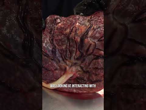 Video: Waarom wordt de placenta verwijderd?