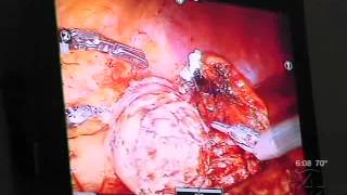 Dr. Ted Brisson - Robotic Partial Nephrectomy