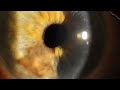 Iris melanoma 3d growing inside eye