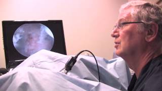 Ablation with Houston ObGyn Dr. Maurice Leibman