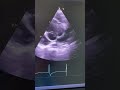 Ascending aortic aneurysm with bicuspid aortic valve . Severe aortic regurgitation