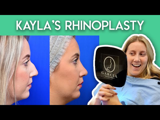 Kayla's Rhinoplasty Journey