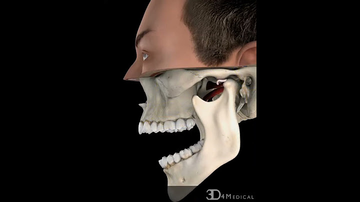 TMJ, with Reduction