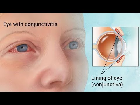 Video: Fluff in the eye - causes, symptoms and treatment