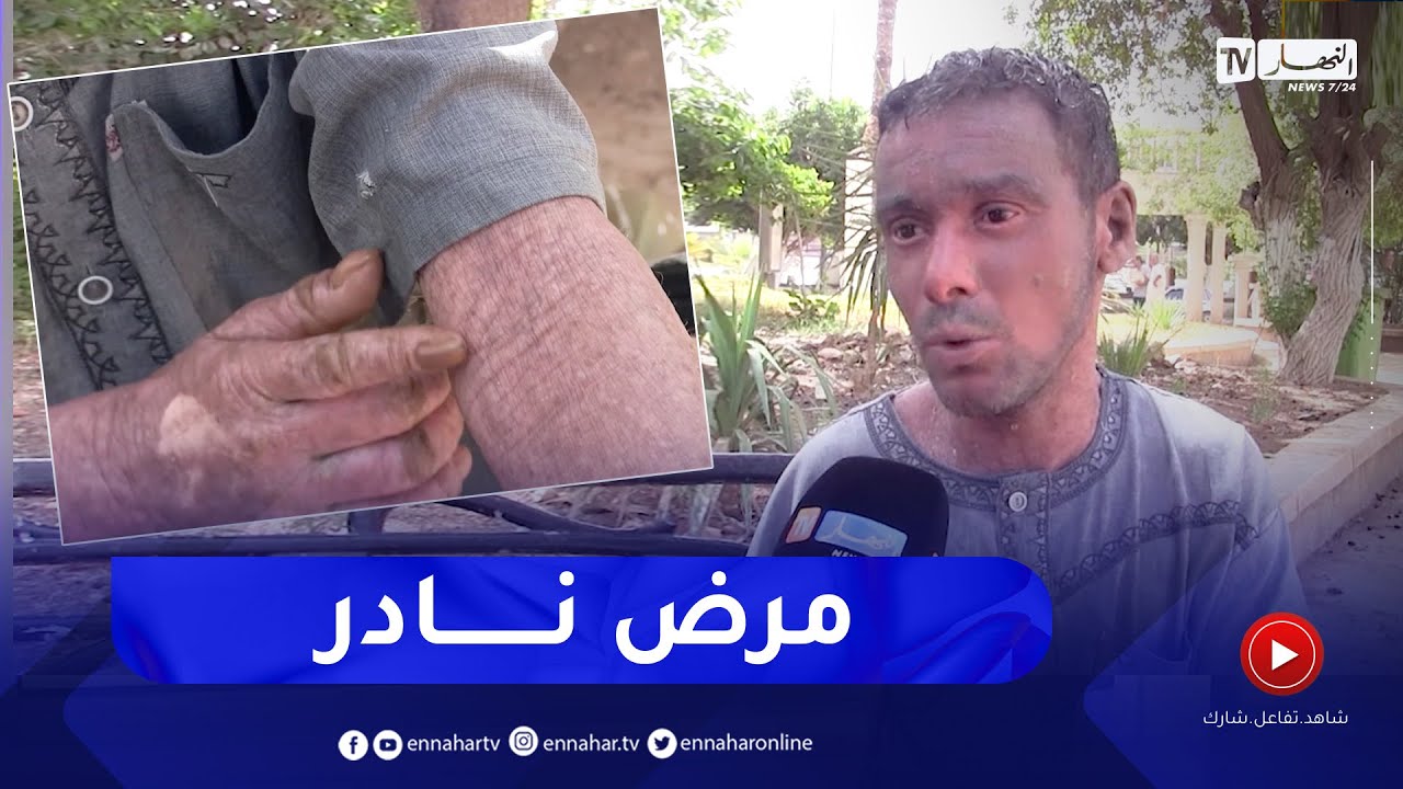 الشلف: مرضى جلد السمك.. معاناة تزيدها درجات الحرارة المرتفعة