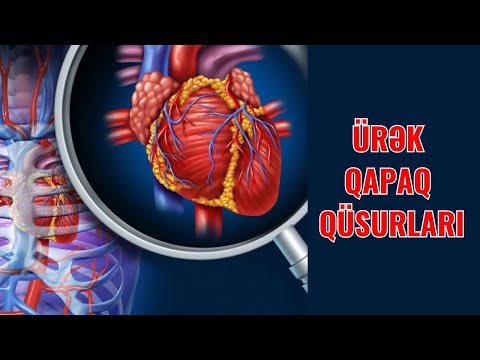 Ürək QAPAQ Çatışmazlığı - Anadangəlmə ÜRƏK QÜSURUDUR?