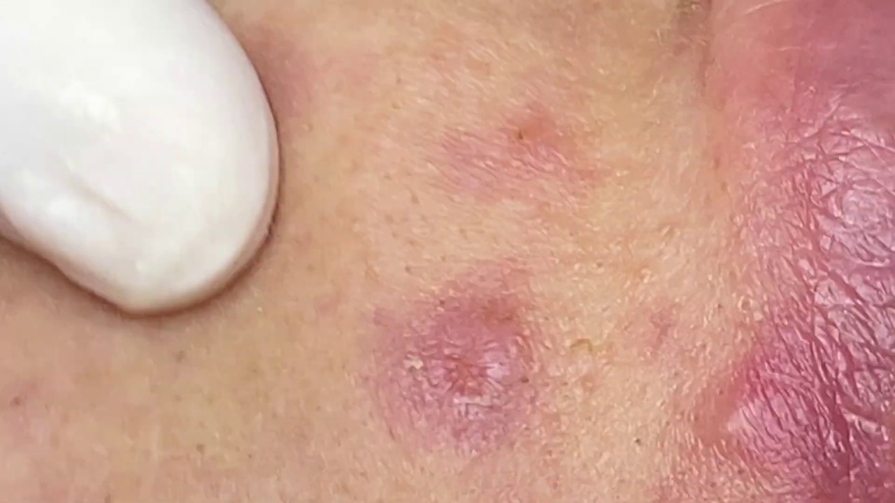 Removing Stubborn Blackhead Acne Years Old | Loại Bỏ Mụn Đầu Đen Cứng Đầu Lâu Năm - SacDepSpa#139