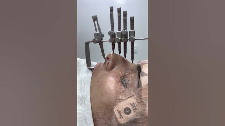 Rinosseptoplastia! Muito além do estético, melhor qualidade de vida para a convidada (paciente)😍