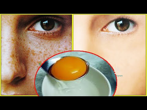 Video Chuẩn Bị 1 Quả Trứng Gà-Bí Quyết TRỊ SẠCH NÁM TÀN... - youtube