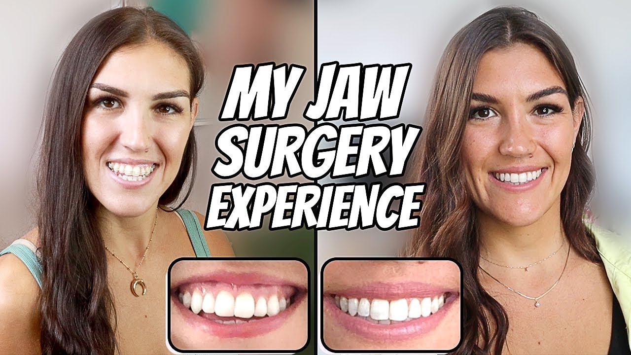 double jaw surgery journey