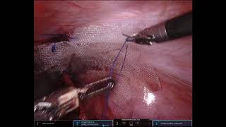 Robotic pyeloplasty on the right side   Part04