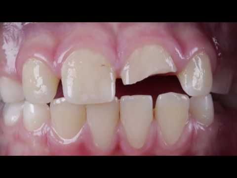 فيديو: كيفية العناية بحشوات الأسنان: 14 خطوة (بالصور)