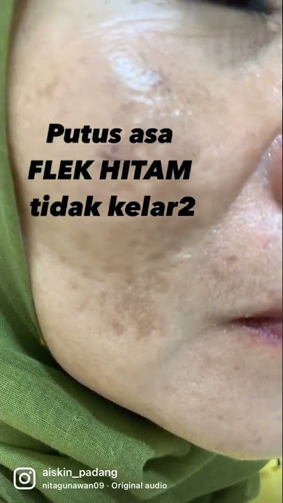 Kenali jenis flek hitam kami sebelum memilih mau pakai perawatan yang mana