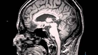 MRI Scan of my brain, arter frontal lobotomy.avi