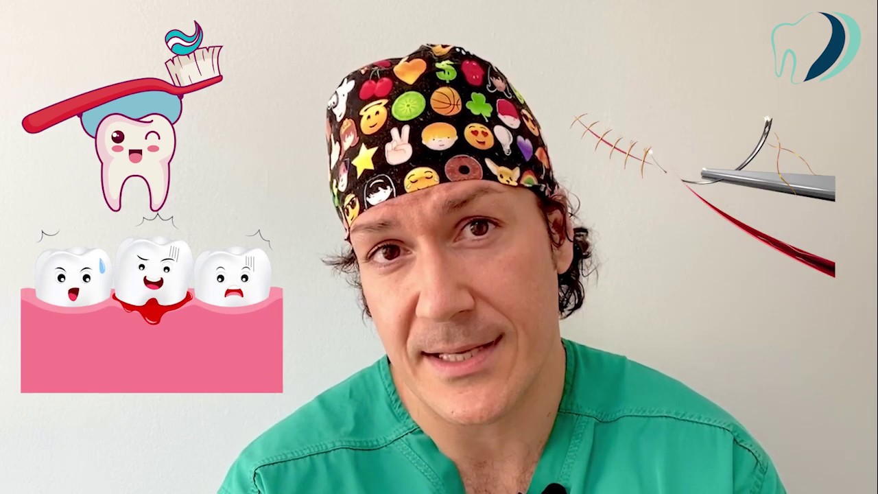 4 cose FONDAMENTALI da sapere dopo l'estrazione di un molare