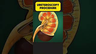 |Ureteroscopy procedure| Ureteroscopy #Urology #KidneyStones