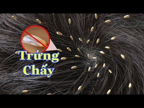 Video: 4 cách để loại bỏ trứng chấy ở đầu