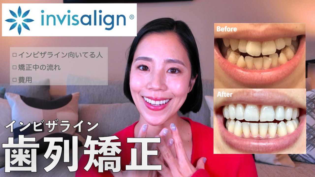 【インビザライン】向いてる人 | メリットデメリット｜費用は？痛い？