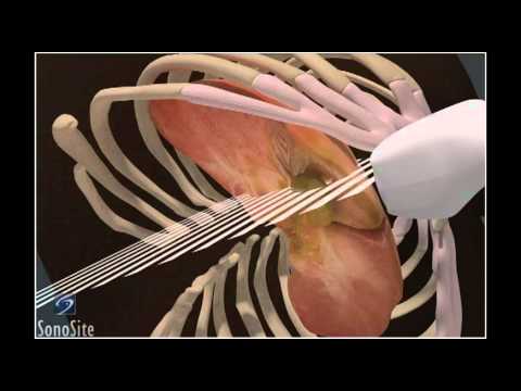 How To: Gallbladder Ultrasound 3D Video