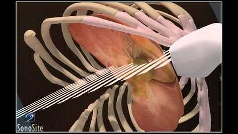 How To: Gallbladder Ultrasound 3D Video