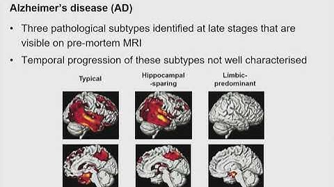 OHBM 2018 | Symposium | Alexandra Young | Identifying neurodegenerative disease subtypes and their…