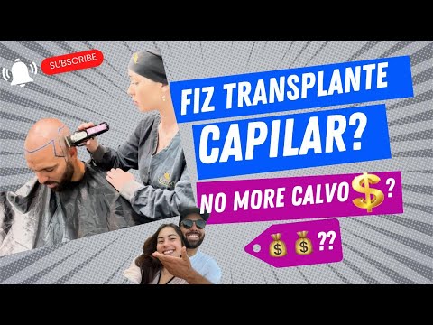 FIZ UM TRANSPLANTE CAPILAR - Fim do Calvo Ibelli? 😂