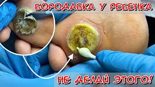 LARGE WART IN A CHILD. HOW TO REMOVE A WART? WART ON THE FOOT #alena_lavrentieva