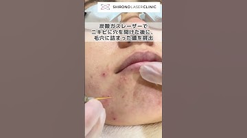 ニキビのレーザー治療  #shorts #にきび #宮本駿