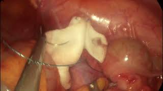 Single port laparoscopic appendectomy