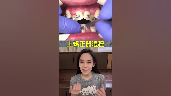 上矯正器過程，戴蒙牙套與傳統牙套差異。 #第一次上矯正器＃戴牙套 #shorts - 天天要聞