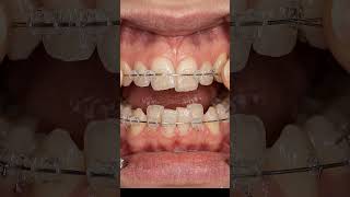 Braces Transformation in 60 Seconds 😳🦷 (Crooked Teeth Fix)
