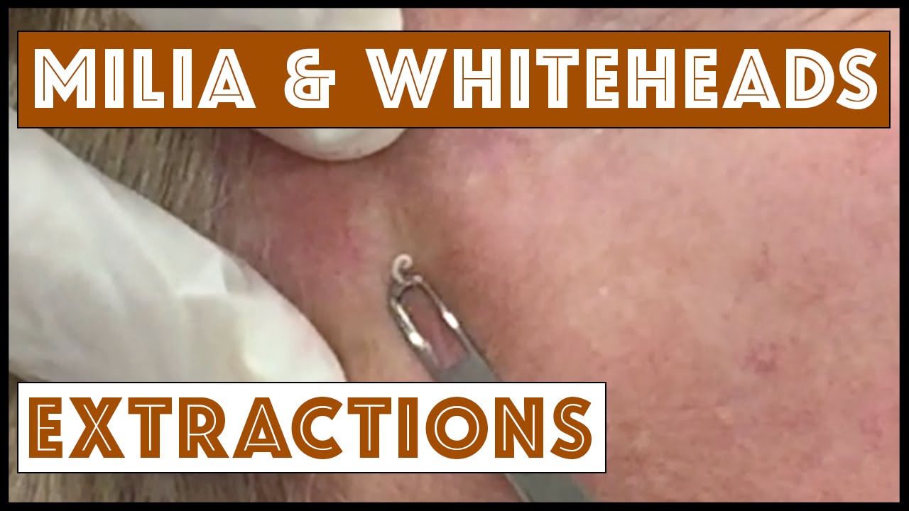 Milia And Whiteheads Extracted On The Face Youtube