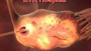 Animation of IUI IVF