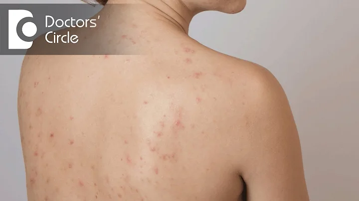 How long does a heat rash last? - Dr. Tina Ramacha...