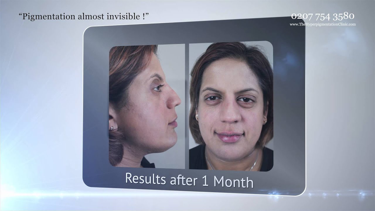 the hyperpigmentation clinic - testimonial - HD