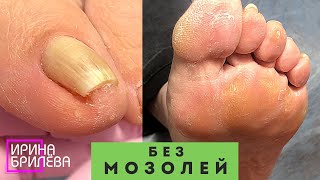 видео: ПЕДИКЮР 🌸 Чтобы не болели пальцы и легче было ходить 🌸 Убираем подногтевые мозоли (Подробное видео) картинка: ПЕДИКЮР 🌸 Чтобы не болели пальцы и легче было ходить 🌸 Убираем подногтевые мозоли (Подробное видео)