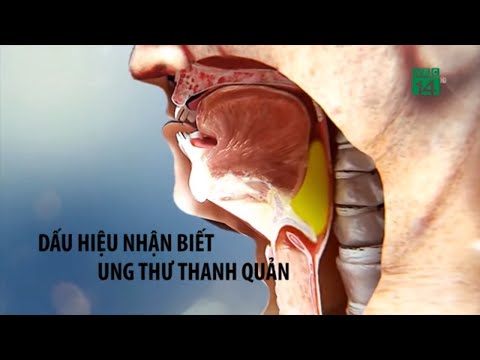 Dấu hiệu nhận biết ung thư thanh quản| VTC14