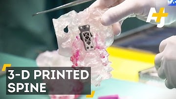 3D Printing Gave This Man A New Spine