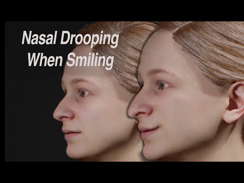 Dynamic Nasal Drooping When Smiling: Cause and Treatment