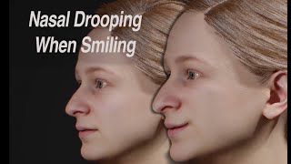 Dynamic Nasal Drooping When Smiling: Cause and Treatment