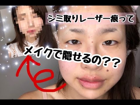 シミ取りレーザー痕はしっかりメイクをすると消える 自宅ケアをご紹介 経過報告 Youtube