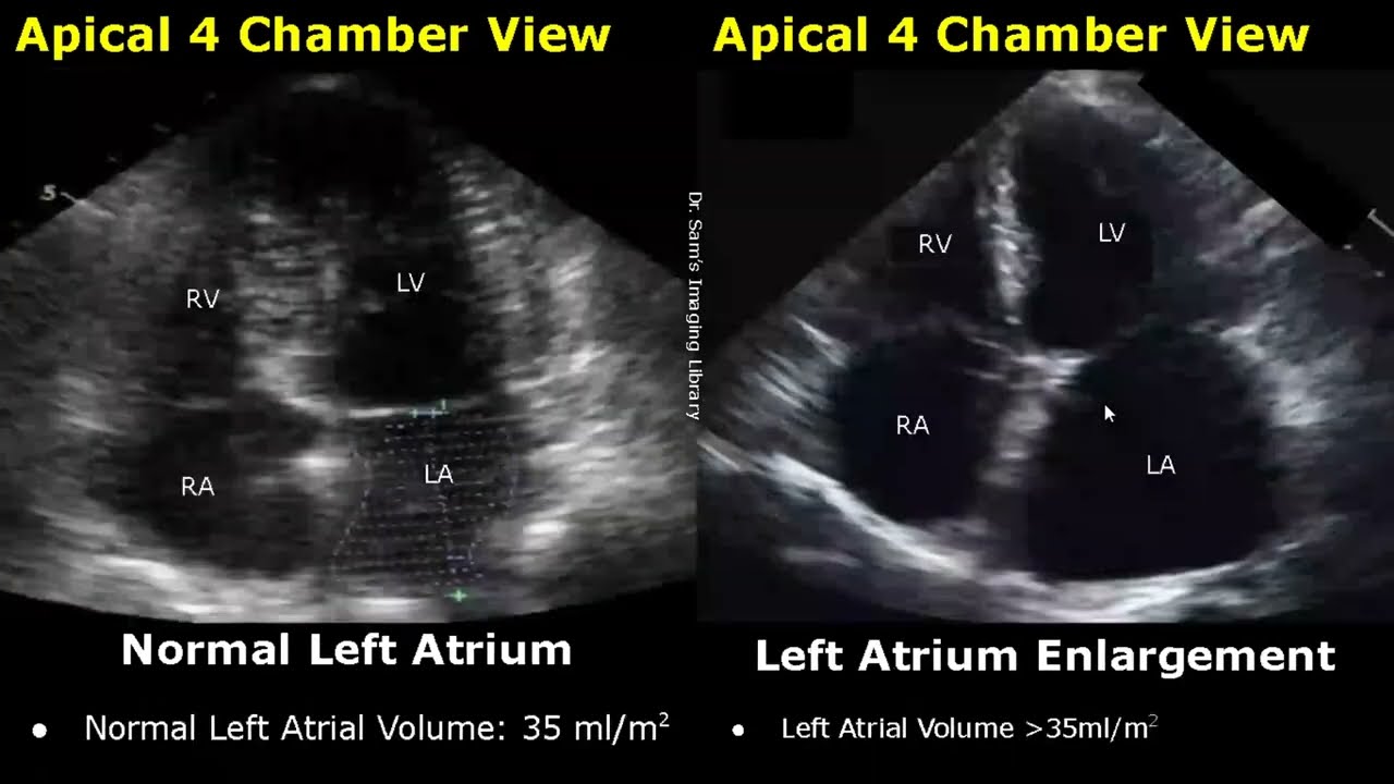 Echocardiography Normal Vs Abnormal Images | Heart Ultrasound | Cardiac  Color/Spectral Doppler Usg - Youtube