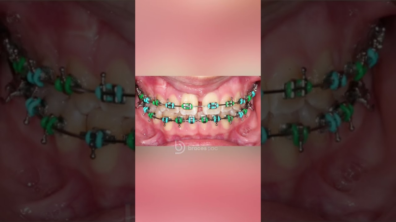 Braces Timelapse - Morph - 20 months in 8 seconds w/ The Braces Doc