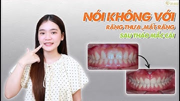 Nói không với răng thưa, mất răng sau tháo mắc cài - KH. Đỗ Bảo Quyên