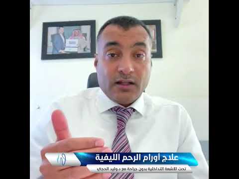 علاج أورام الرحم الليفية تحت الأشعة التداخلية بدون جراحة