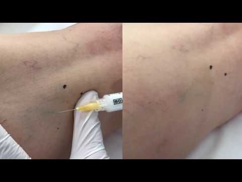 Vídeo: Procedimiento De Escleroterapia De Venas