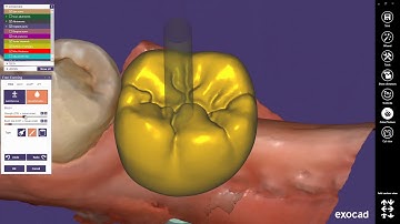 Neodent Exocad library installation instructions for beginners